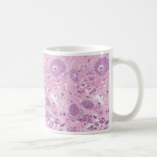 Taza De Café Células cancerosas del Taza-Pecho del café