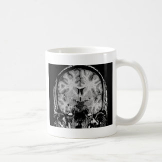Taza De Café Cerebro MRI, rebanada coronal