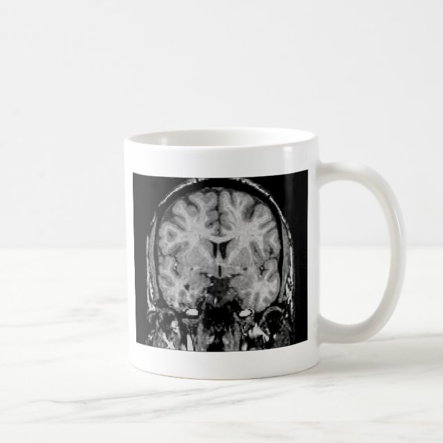 Taza De Café Cerebro MRI, rebanada coronal (Derecha)