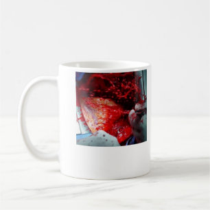 Taza De Café Disección aórtica ascendente