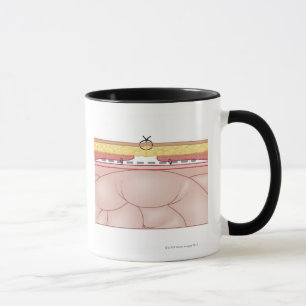 Taza Ilustracion de una hernia