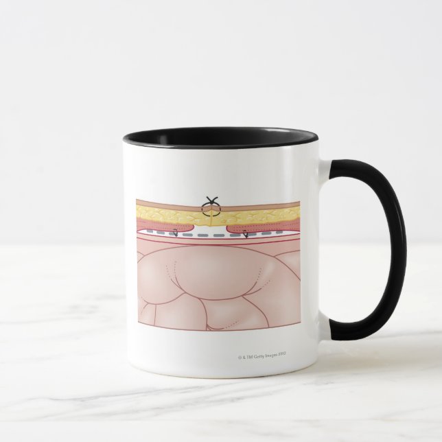 Taza Ilustracion de una hernia (Derecha)