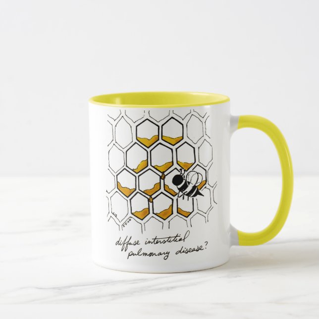 Taza intersticial difusa de la enfermedad pulmonar (Derecha)