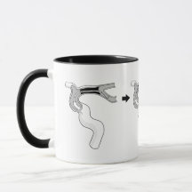 Mug de Trombectomía