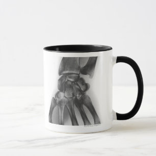 Taza Muñeca normal, radiografía