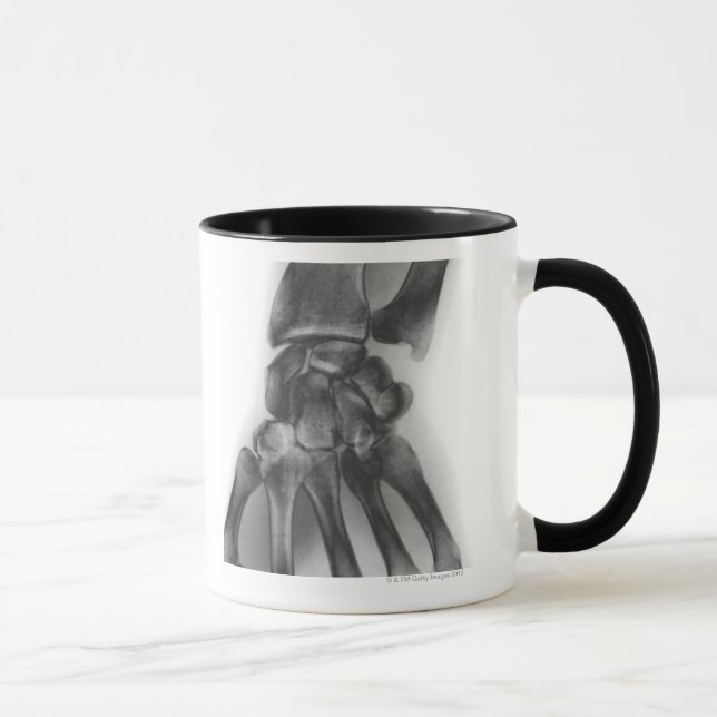 Taza Muñeca normal, radiografía (Derecha)