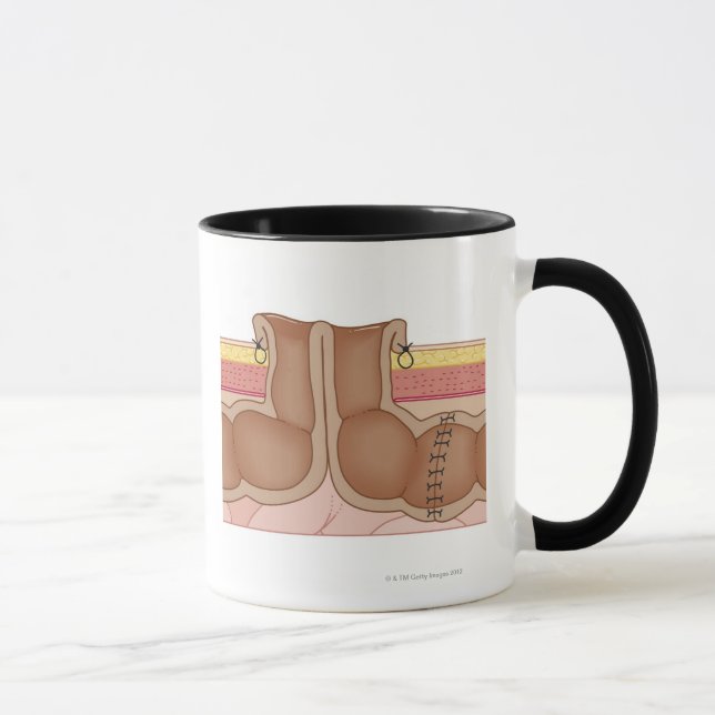 Taza Operación del intestino grueso temporal (Derecha)