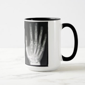 Taza Reina en la radiografía de la mano