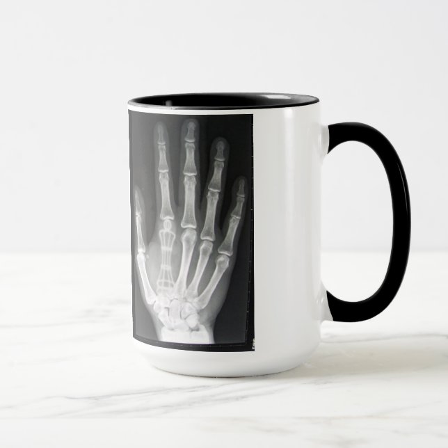 Taza Reina en la radiografía de la mano (Derecha)