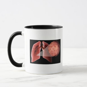 Taza Vía aérea de Inflammed durante un ataque de asma