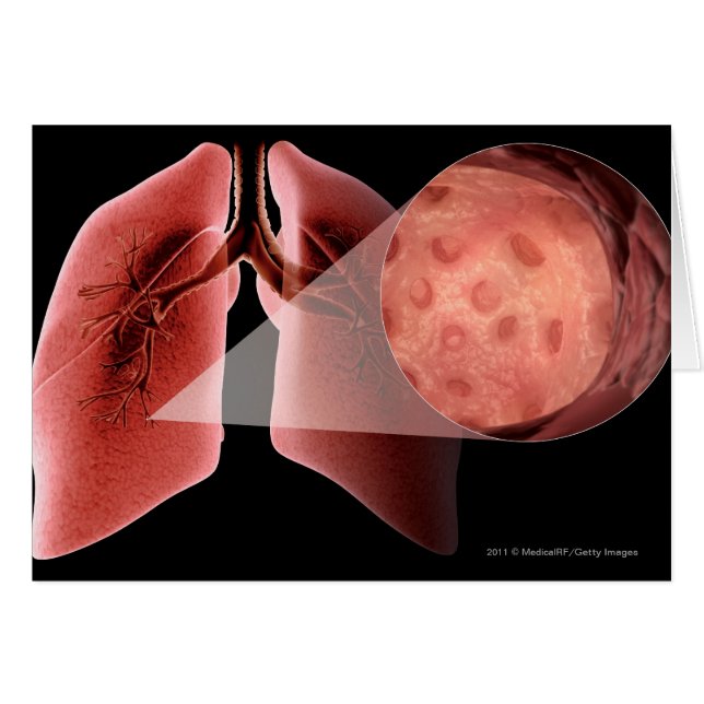 Vía aérea de Inflammed durante un ataque de asma (Anverso (Horizontal))