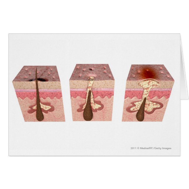 Vista de las causas del acné (Anverso (Horizontal))