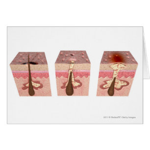 Vista de qué causa acné